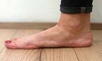  کف پای صاف تنها در صورتی نیاز به درمان دارد که ایجاد ناراحتی کند